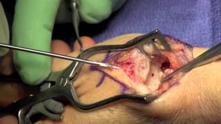 thumb cmc arthroplasty